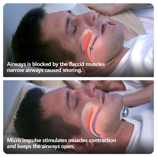 Smart Anti-Snoring Device – Electronic Muscle Stimulator Pro | Drug-Free Sleep Aid | Model YA4300